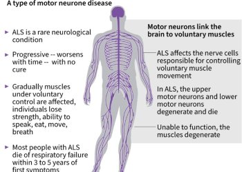 Amyotrophic lateral sclerosis. ©AFP