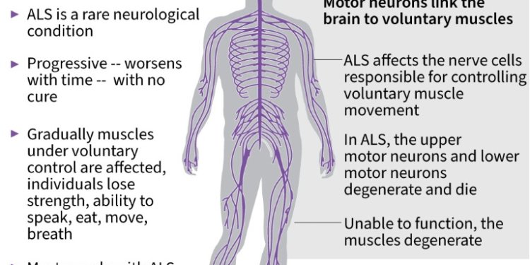 Amyotrophic lateral sclerosis. ©AFP